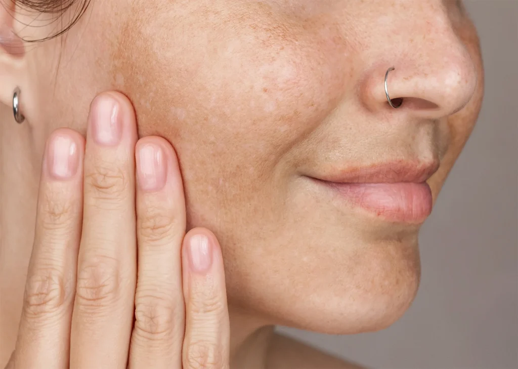 Skin Getting Darker Without Sun Exposure in Hyderabad